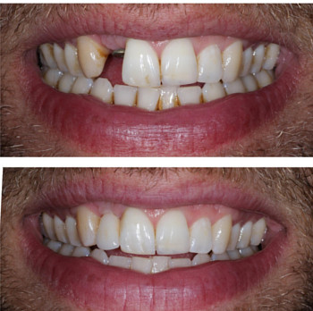 Dental Implants San Francisco Before and After 2