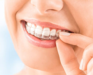 Vivera Retainers in San Francisco